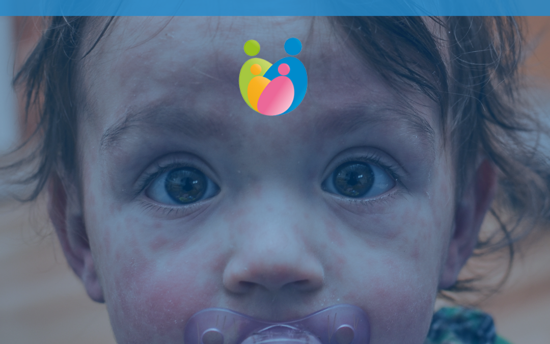 Sarampión: síntomas, riesgos y la importancia de la prevención